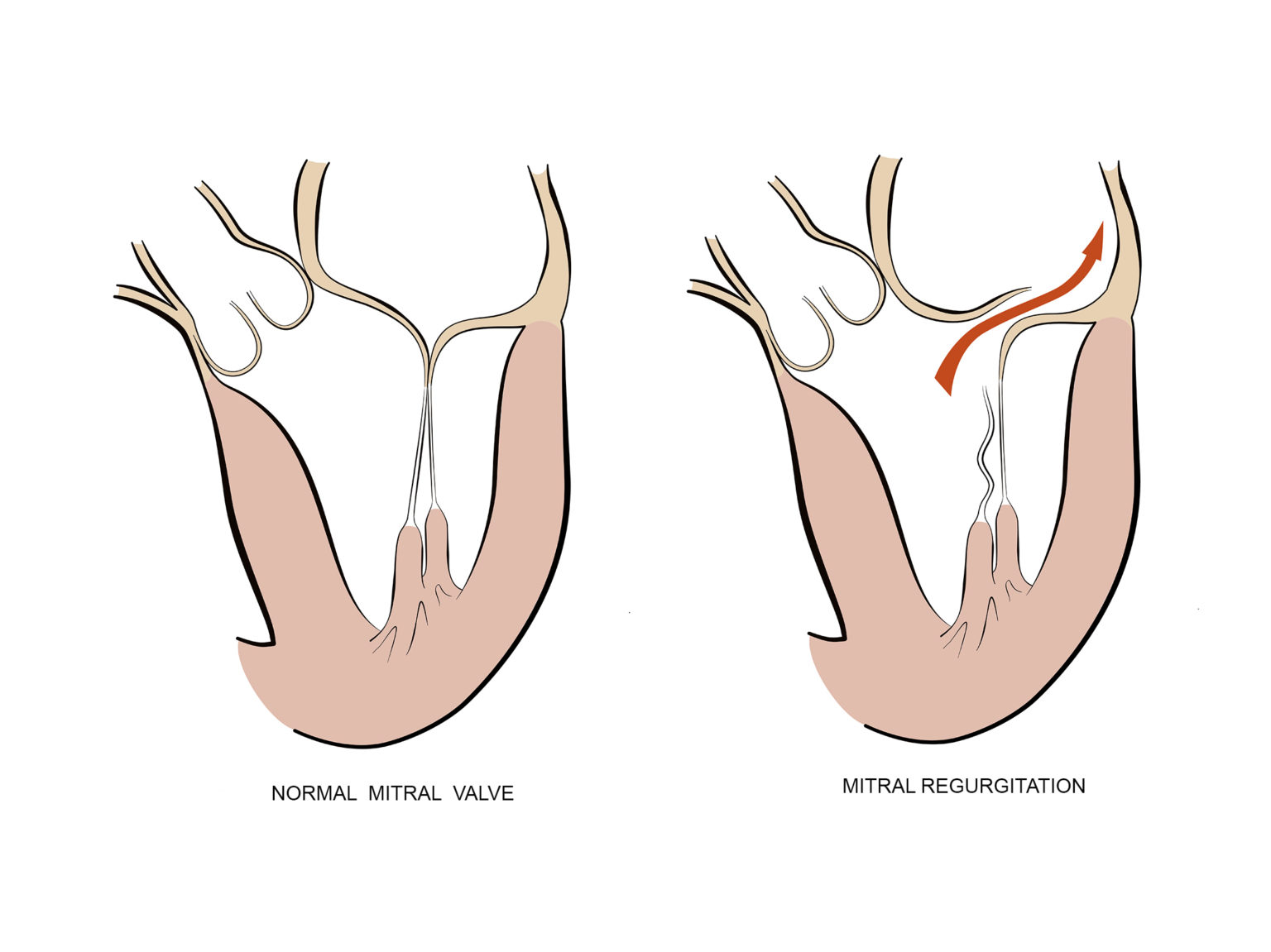 mitral-valve-surgery-kardiohirurgija-rs