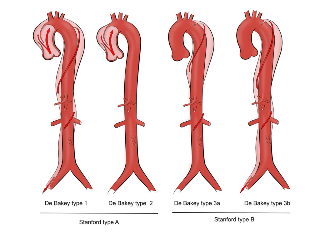 Aortic Surgery - Kardiohirurgija.rs